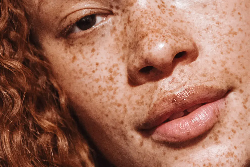Everything You Wanted To Know About Freckles