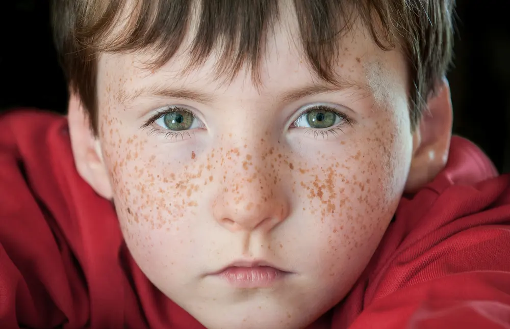 What Causes Fabulous Freckles?