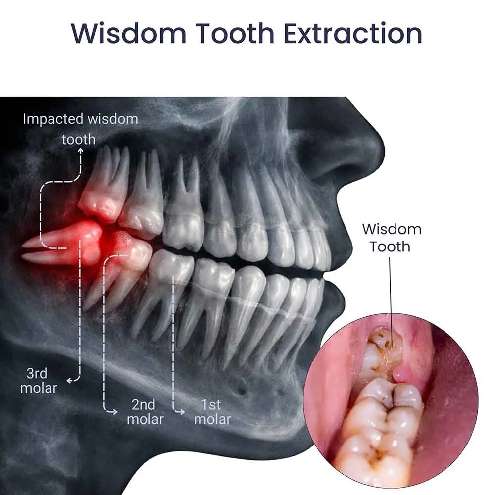 Wisdom Teeth Extraction in Glendale, Queens, NY
