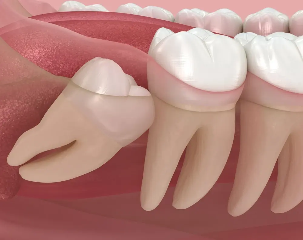 Wisdom Teeth Removal Brownsville, TX