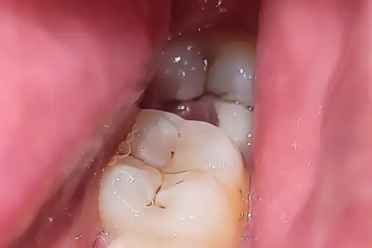 What Are Wisdom Teeth and When Should They Be Removed?